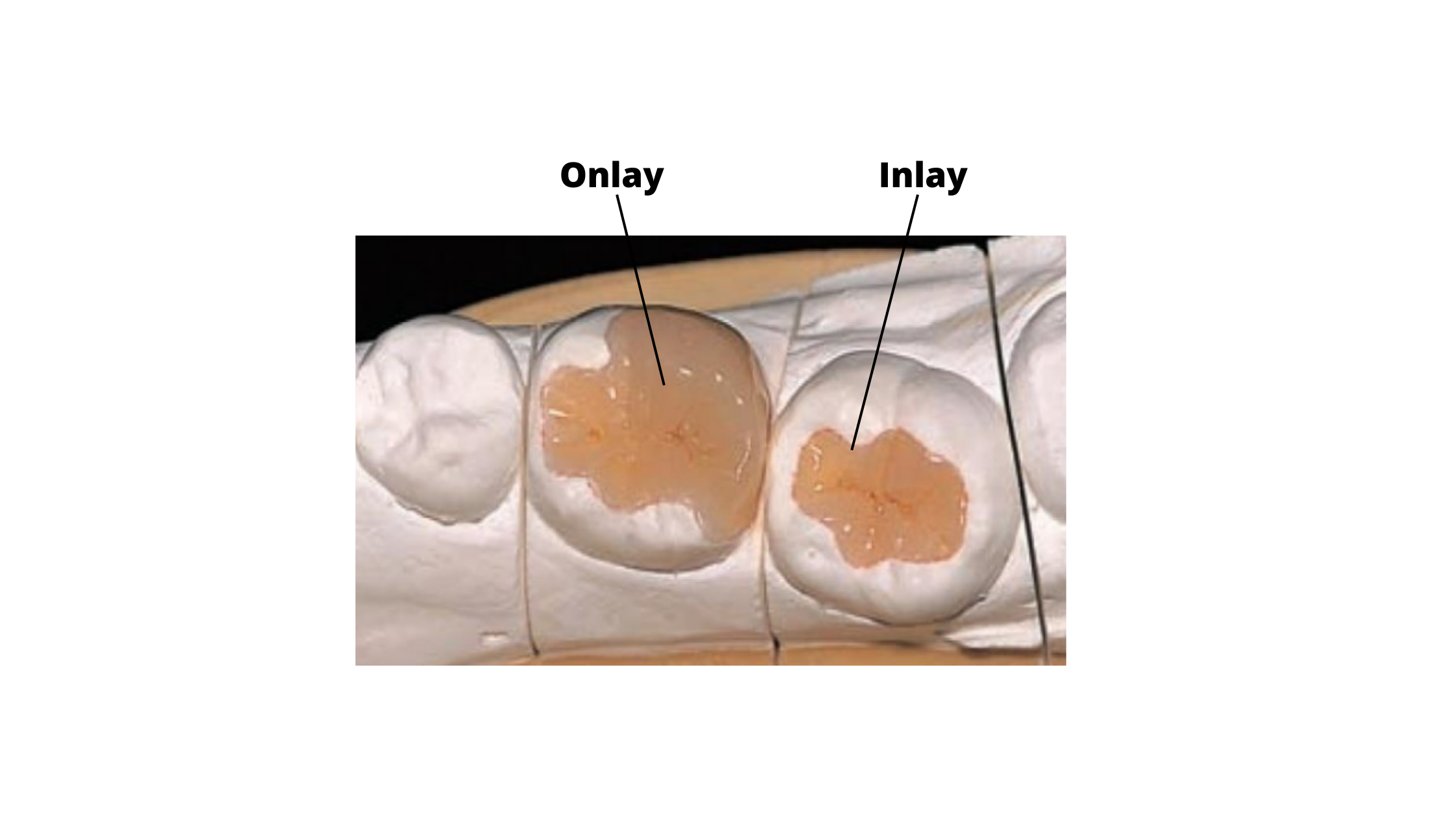 Inlay and Onlay for back teeth